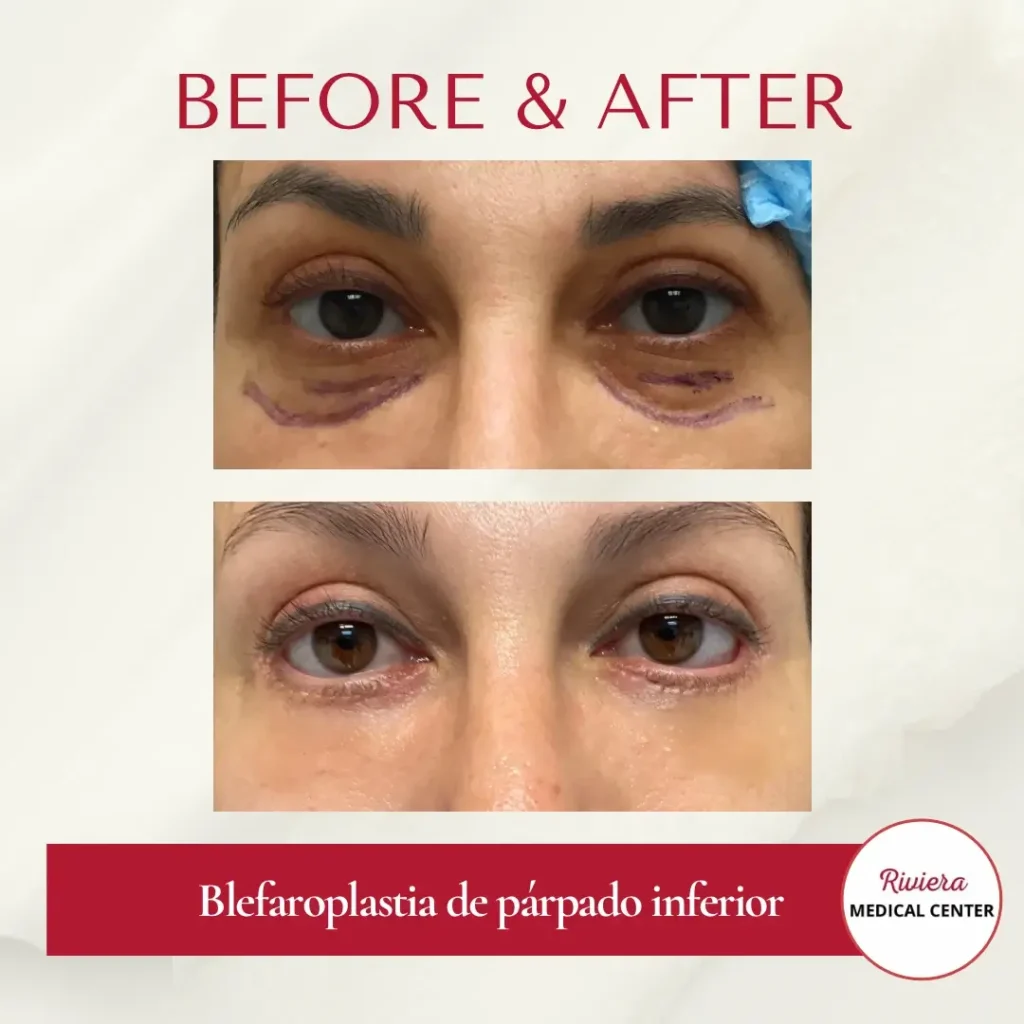 Blepharoplasty