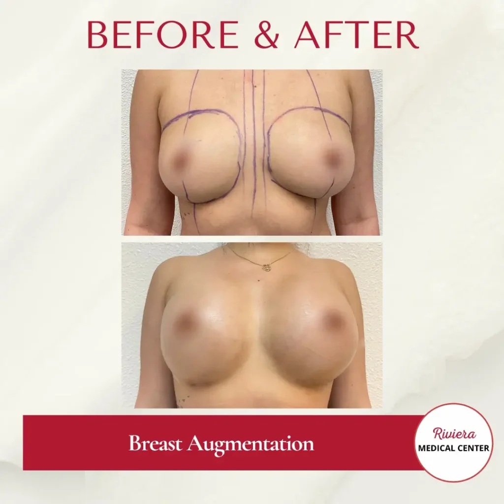 Breast Augmentation 1