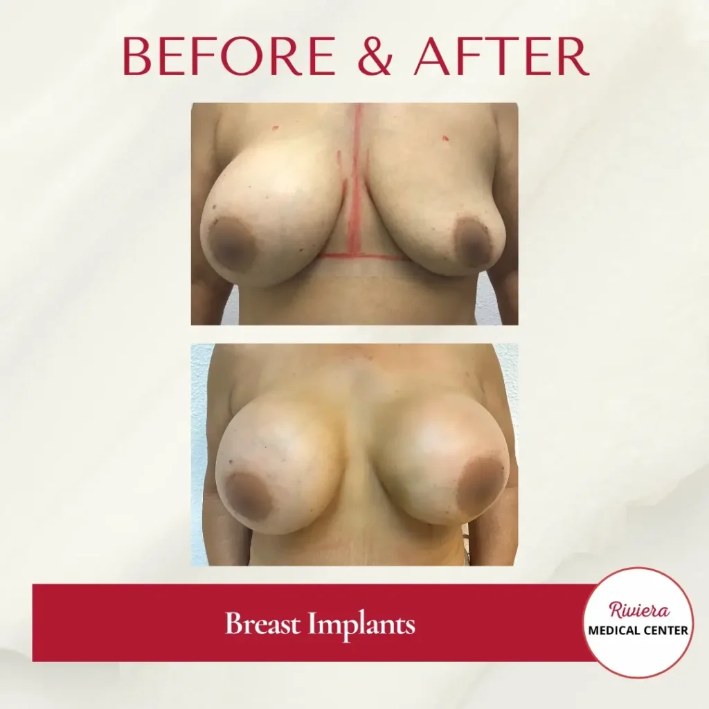 Breast Augmentation 10