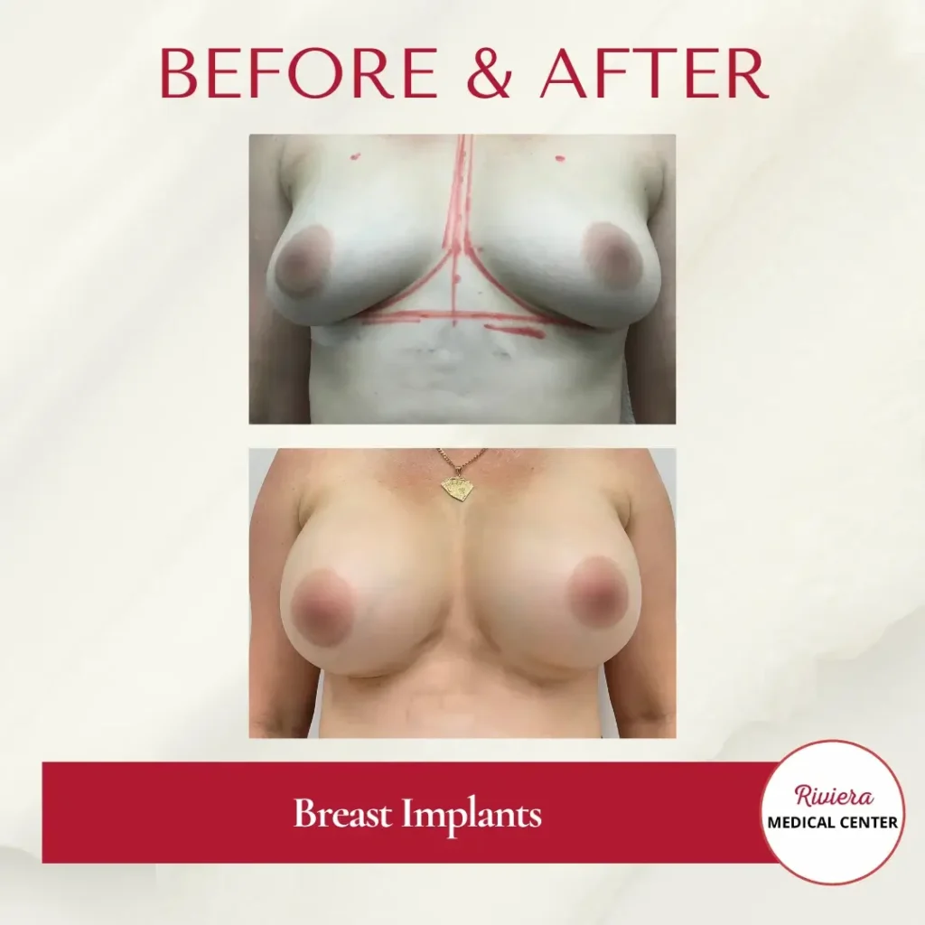 Breast Augmentation 11