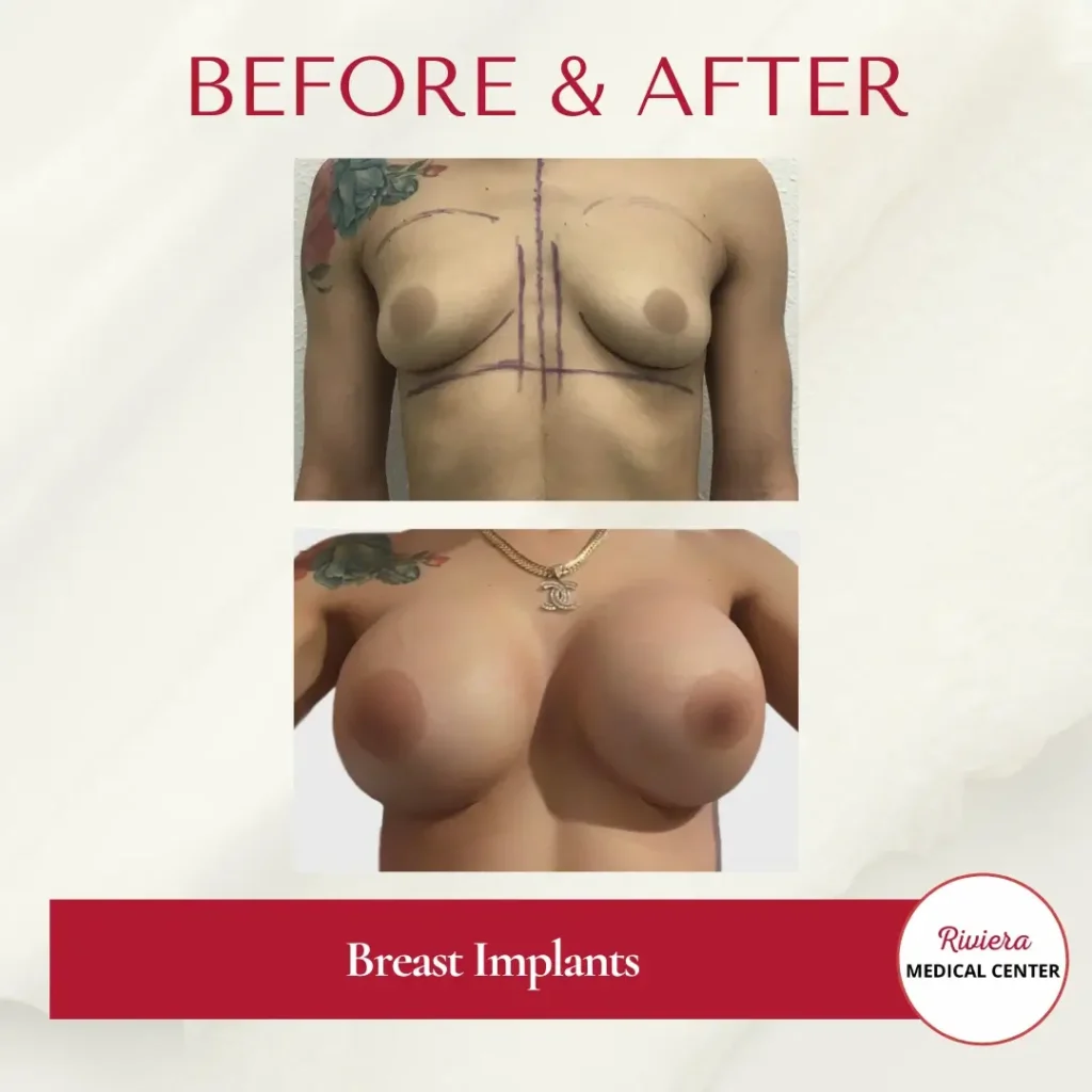 Breast Augmentation 13