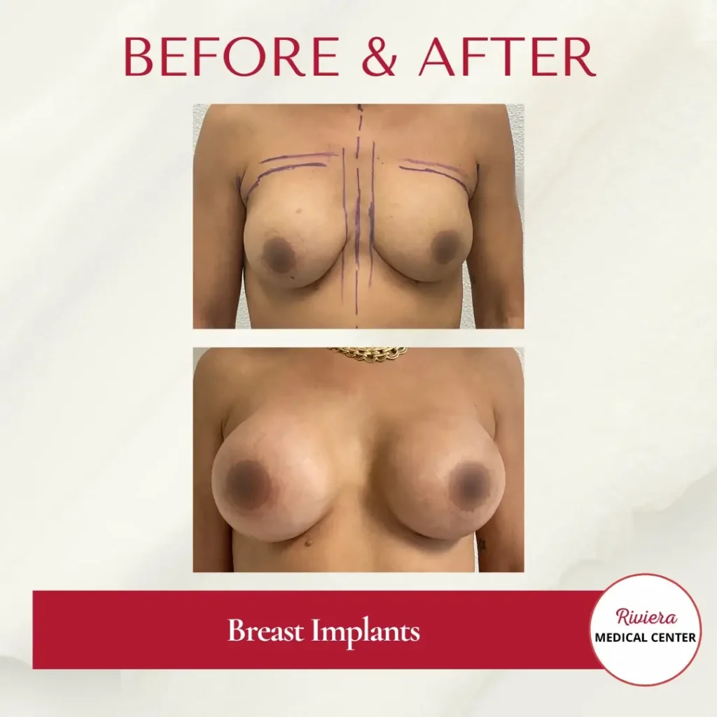 Breast Augmentation 14