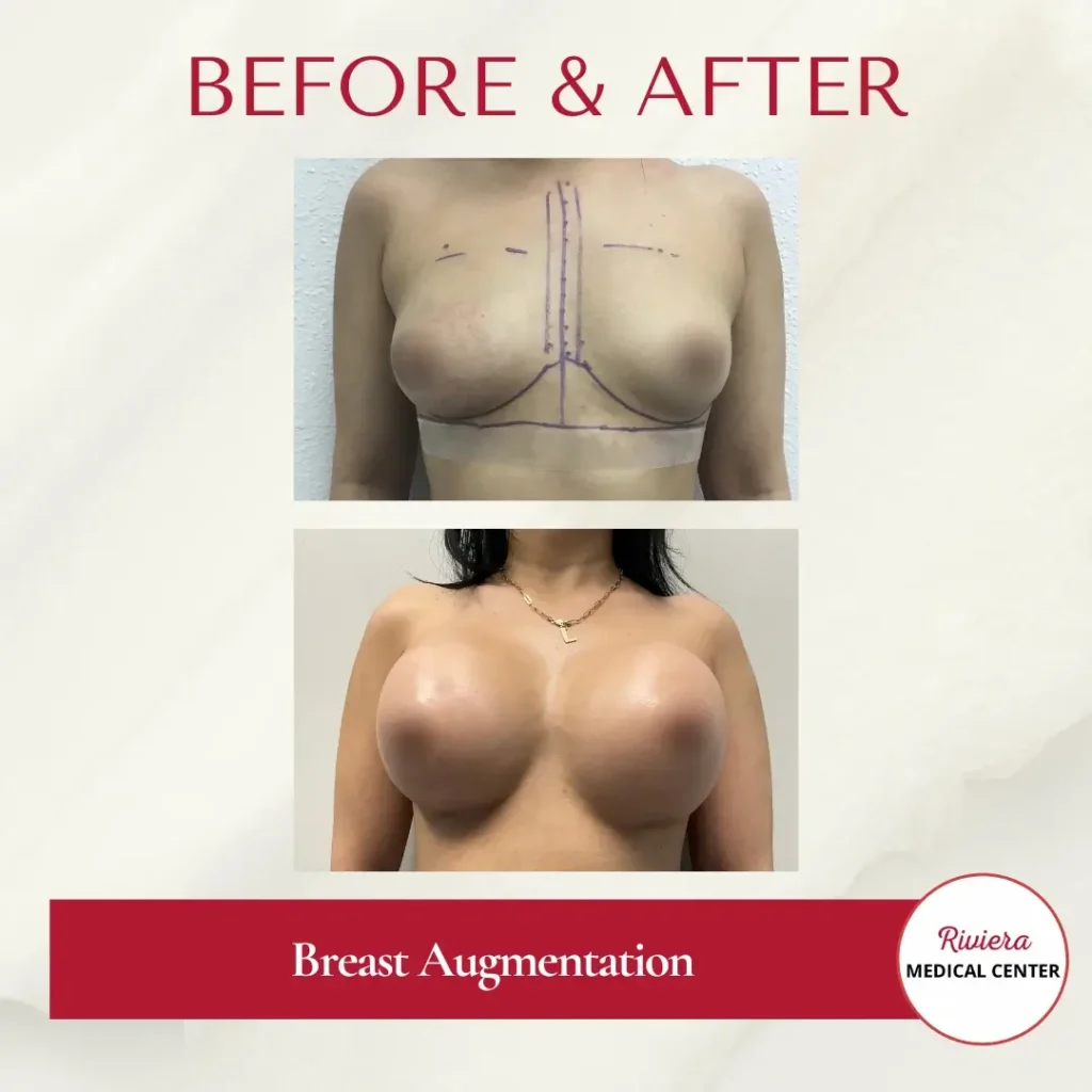 Breast Augmentation 2