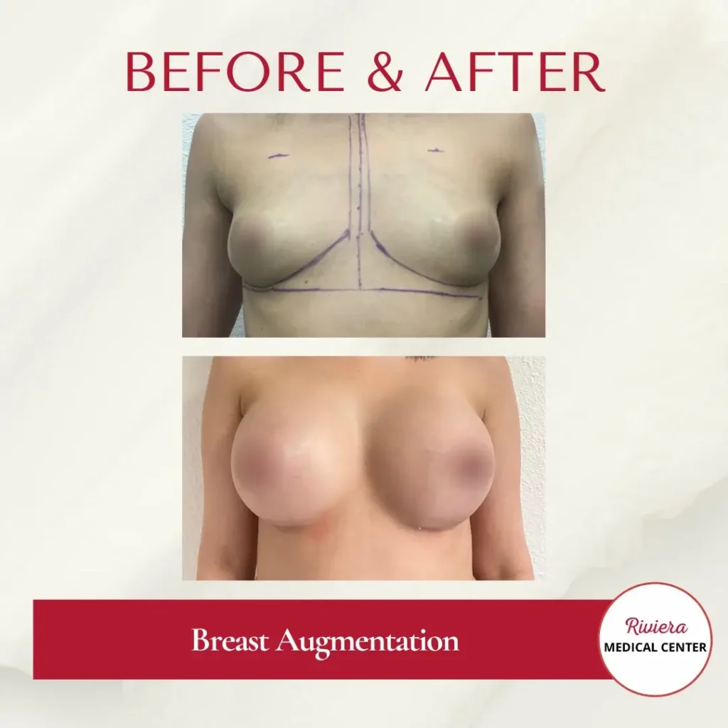 Breast Augmentation 3