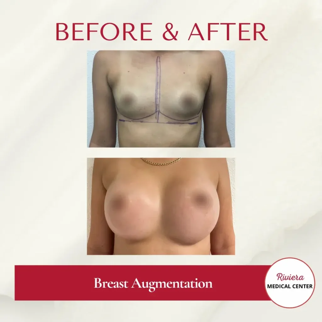 Breast Augmentation 4