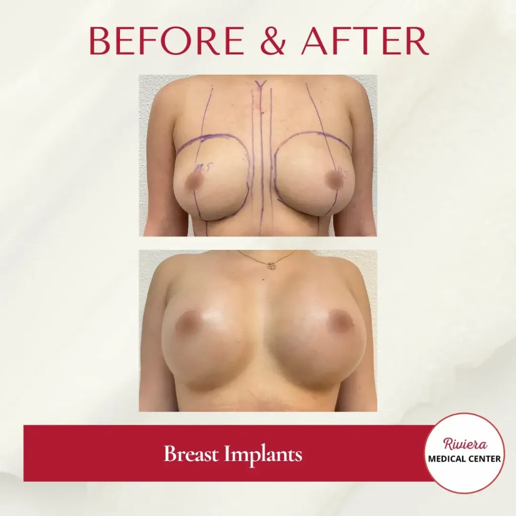 Breast Augmentation 5