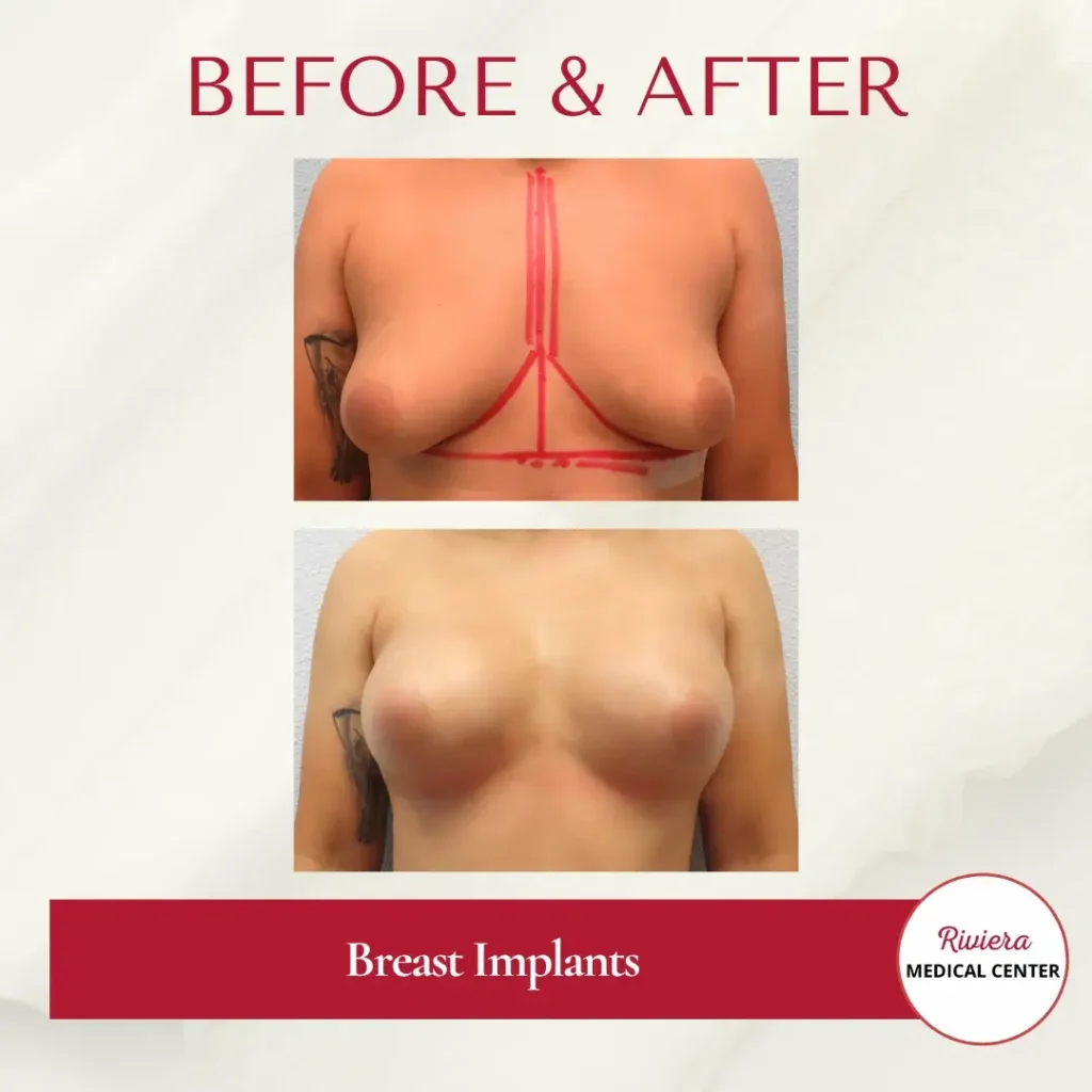 Breast Augmentation 6