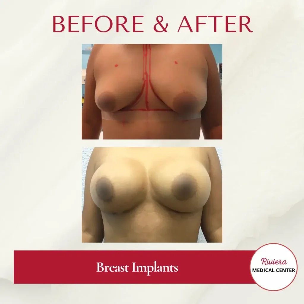 Breast Augmentation 7