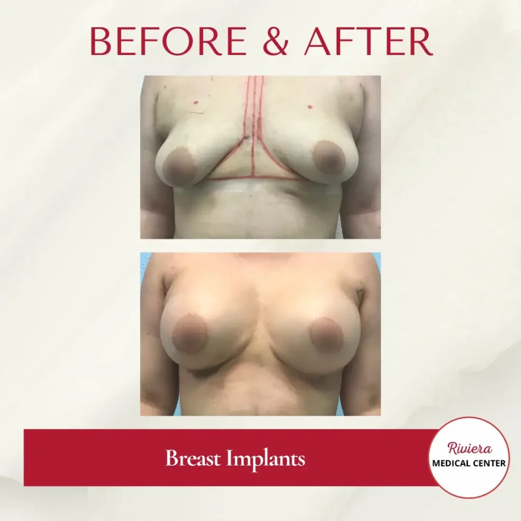 Breast Augmentation 8