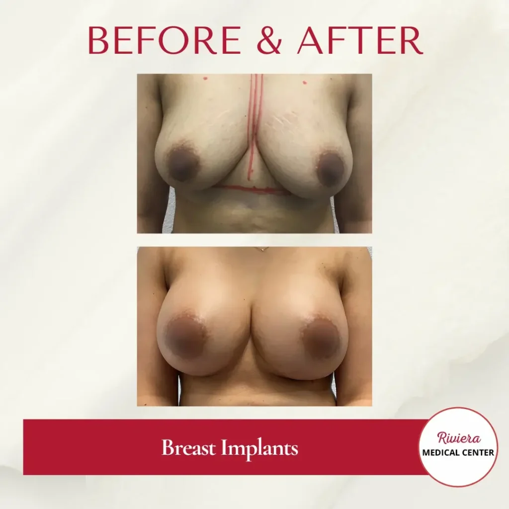 Breast Augmentation 9