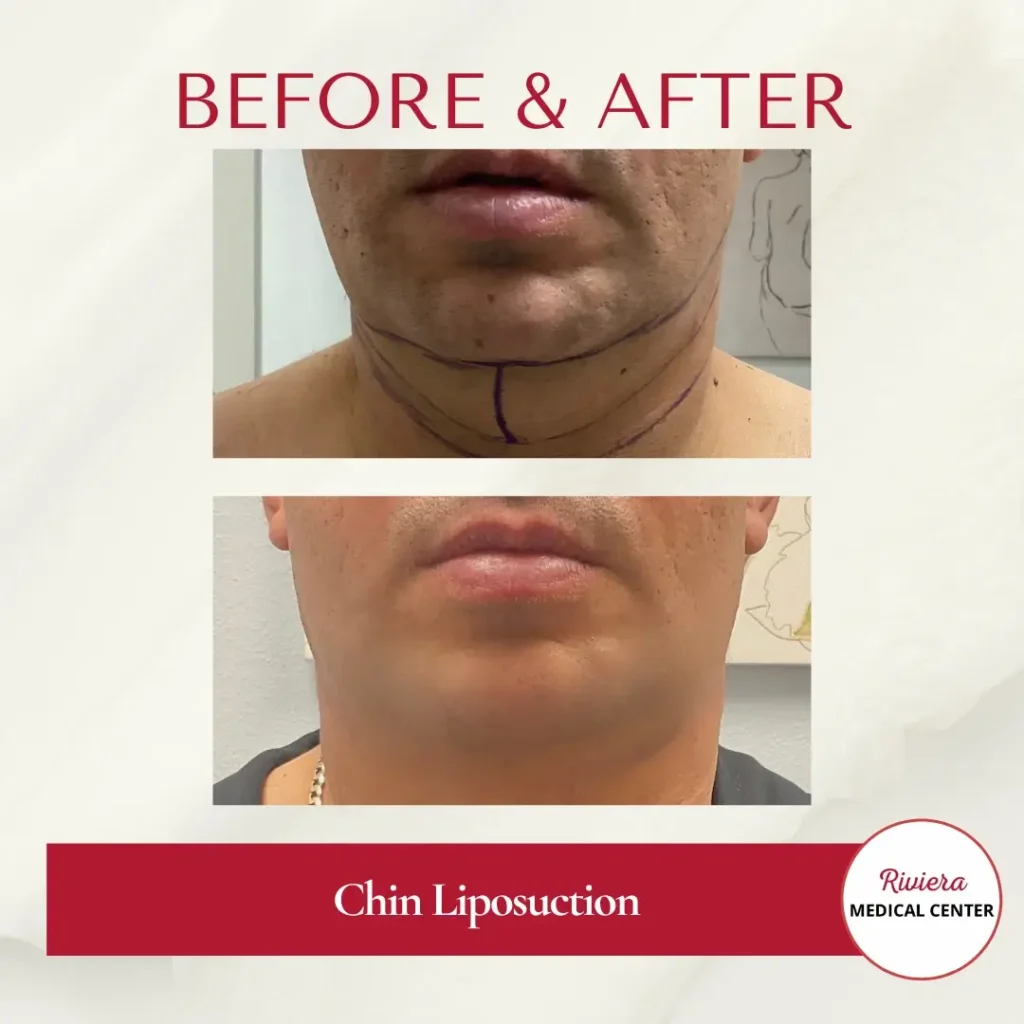 Chin Liposuction 1