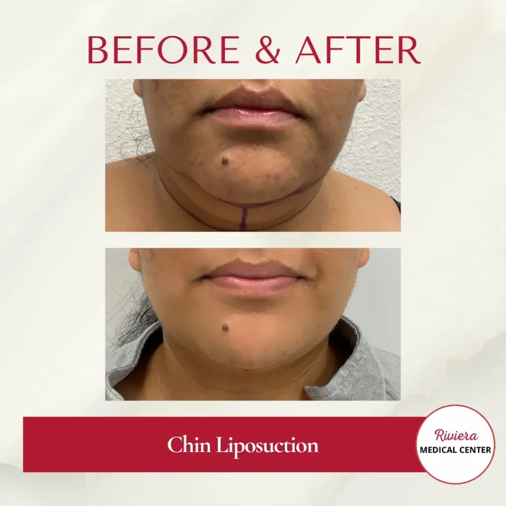 Chin Liposuction 2